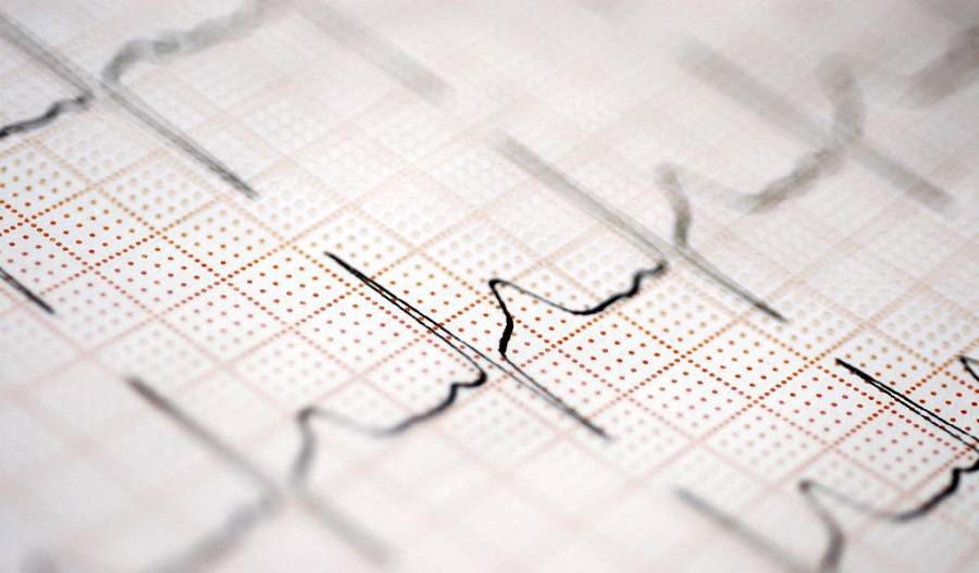 الکتروکاردیوگرام و نوار قلب (ECG)