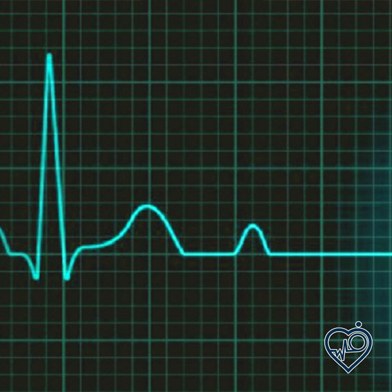ایست قلبی چیست، تشخیص و درمان آن چگونه است؟